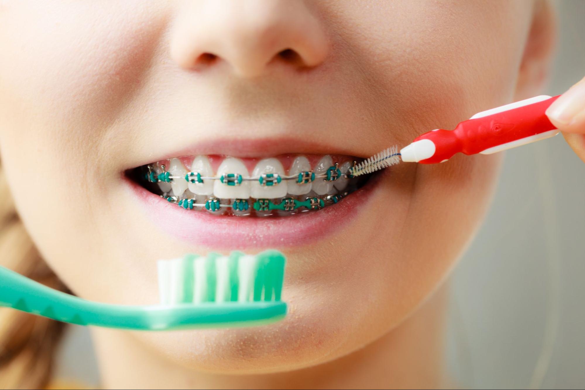 How To Care for Your Braces
