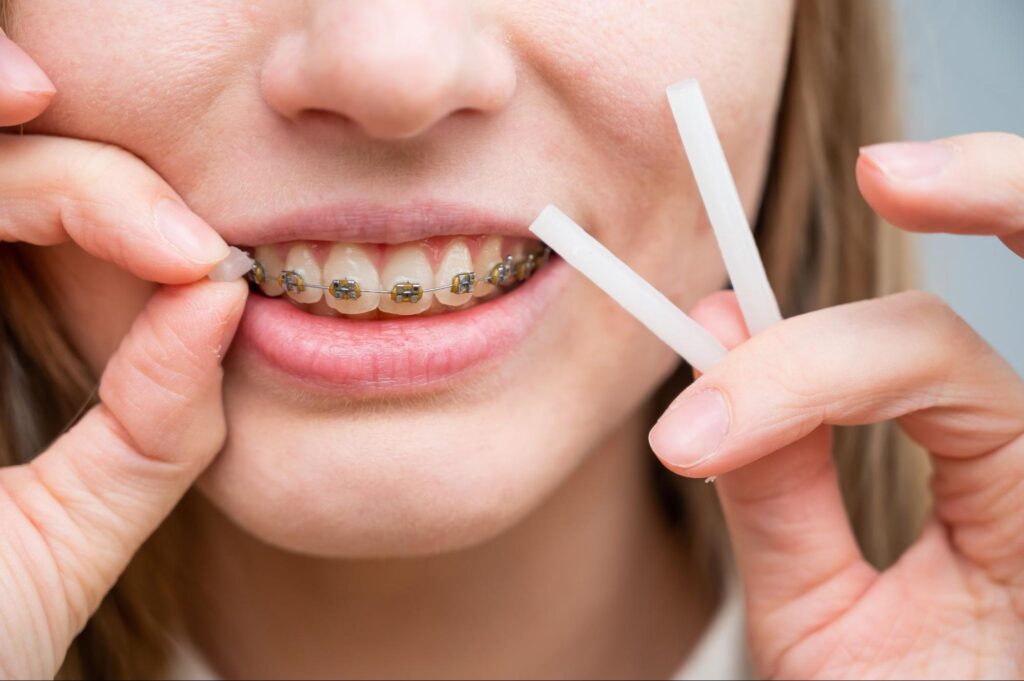 How To Avoid Common Orthodontic Setbacks